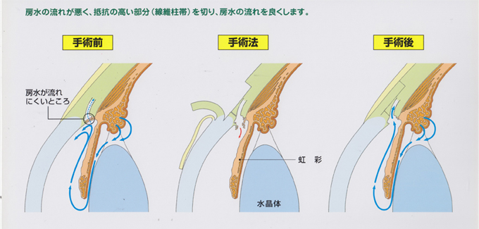 線維柱帯切開術