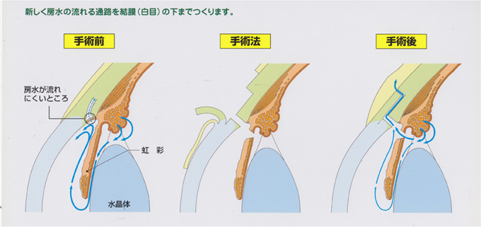 線維柱帯切除術